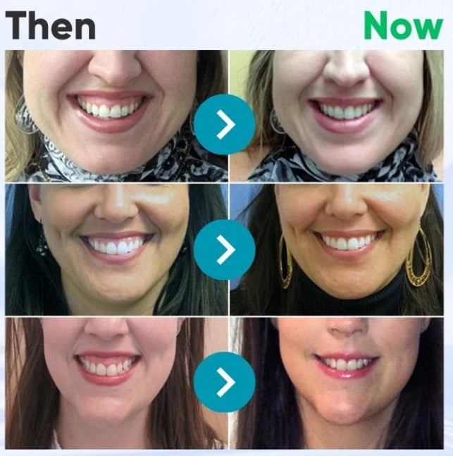 Smileasego™ Focussmile bee venom treatment powder for oral use🦷