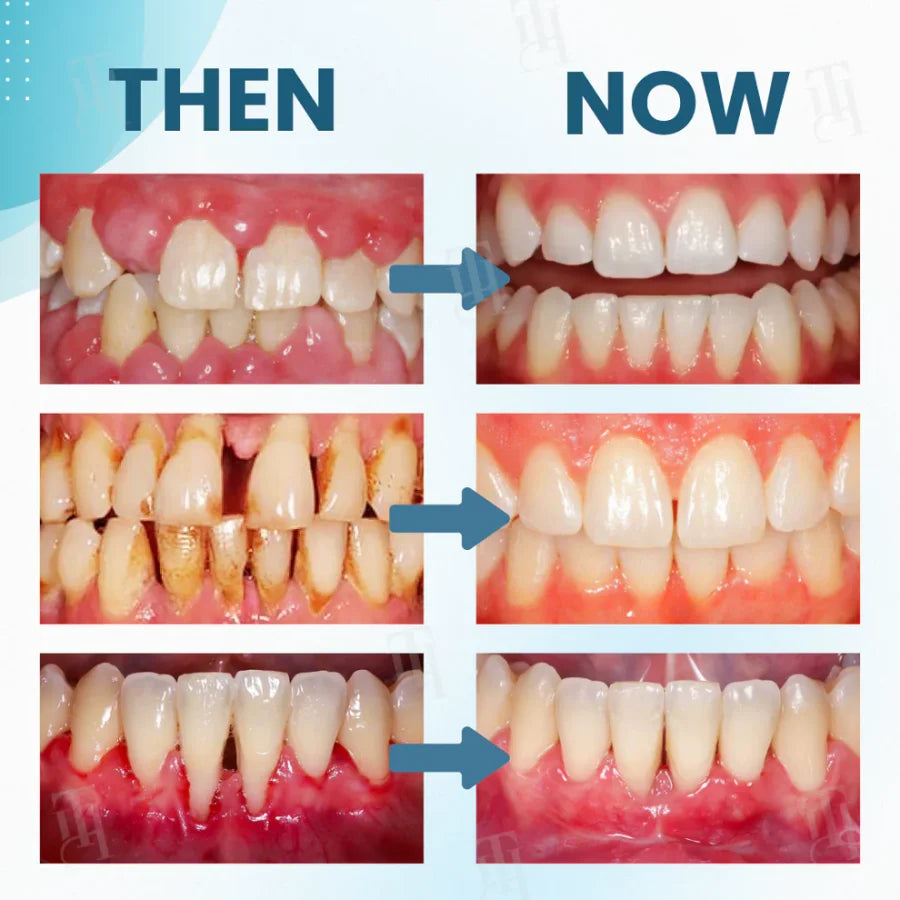 Smileasego™ Focussmile bee venom treatment powder for oral use🦷
